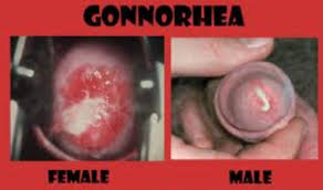discharge gonorrhea symptoms